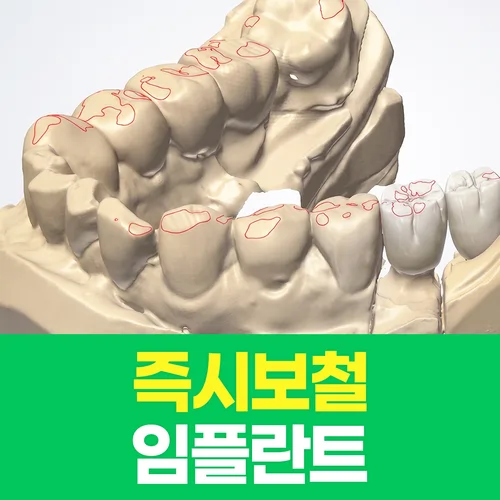 맞춤임플란트